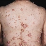 http://n3.datasn.io/data/api/v1/n3_chennan/skin_disease_1/by_table/skin_disease_image_access/df/b0/5d/1a/dfb05d1adeca1171e1f336e27ecc5d851957b4ba.jpg