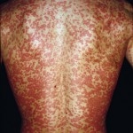 http://n3.datasn.io/data/api/v1/n3_chennan/skin_disease_1/main/skin_disease_image//02/ca/0c/34/02ca0c343891f4b0804d88a38cc50be599422b53.jpg