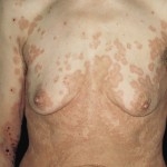 http://n3.datasn.io/data/api/v1/n3_chennan/skin_disease_1/main/skin_disease_image//09/f2/3e/6e/09f23e6e7d0f1bd7f418e31d596284ada973d34f.jpg